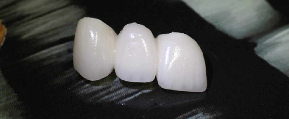 Br. Broggi crown Teeth